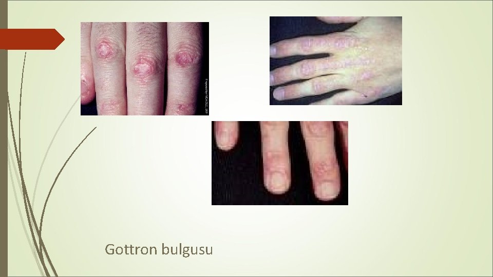 Gottron bulgusu Gottron bulgusu