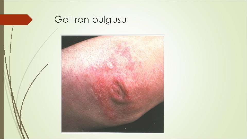 Gottron bulgusu Gottron bulgusu