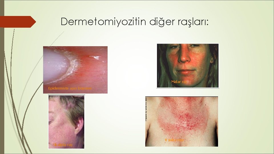 Dermetomiyozitin diğer raşları: Malar raş Epidermiste aşırı büyüme V yaka raşı Skalpta raş Dermetomiyozitin diğer raşları: Malar raş Epidermiste aşırı büyüme V yaka raşı Skalpta raş