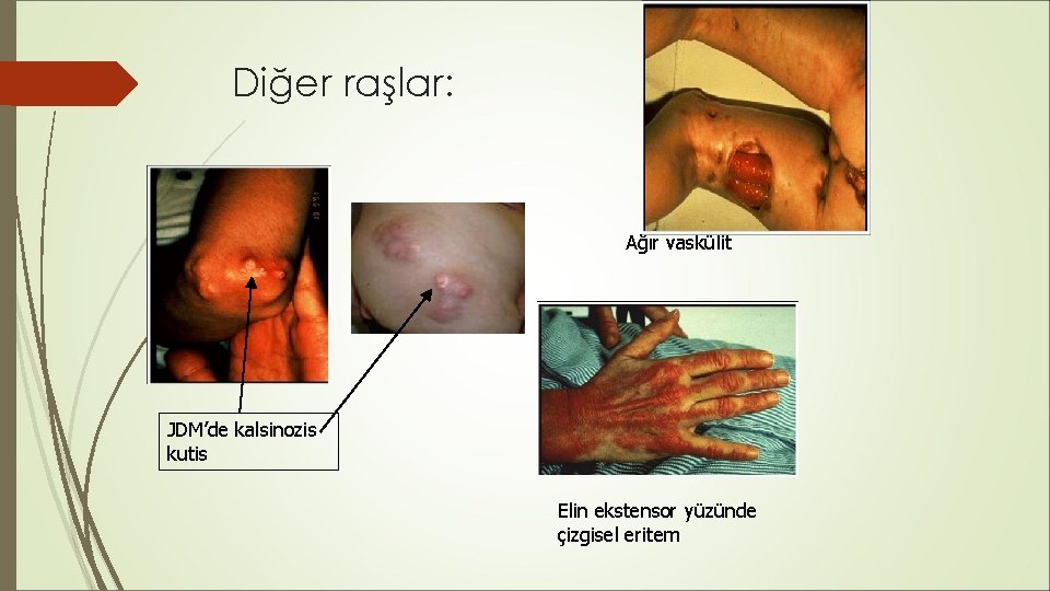 Diğer raşlar: Ağır vaskülit JDM’de kalsinozis kutis Elin ekstensor yüzünde çizgisel eritem Diğer raşlar: Ağır vaskülit JDM’de kalsinozis kutis Elin ekstensor yüzünde çizgisel eritem