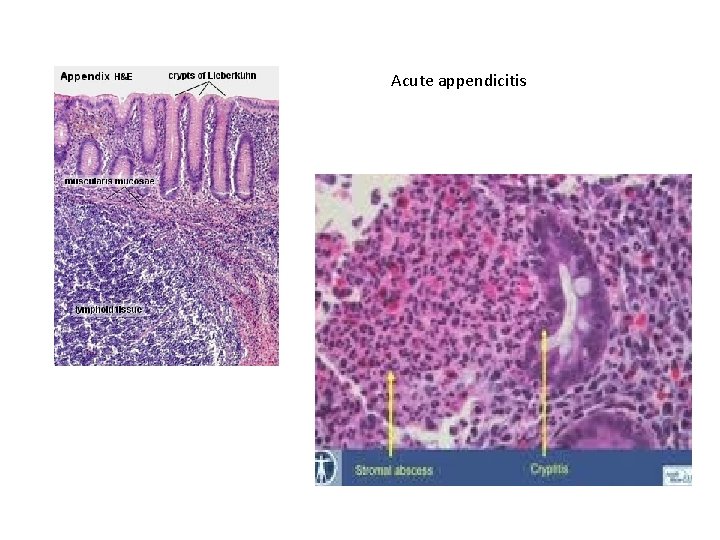 Acute appendicitis 