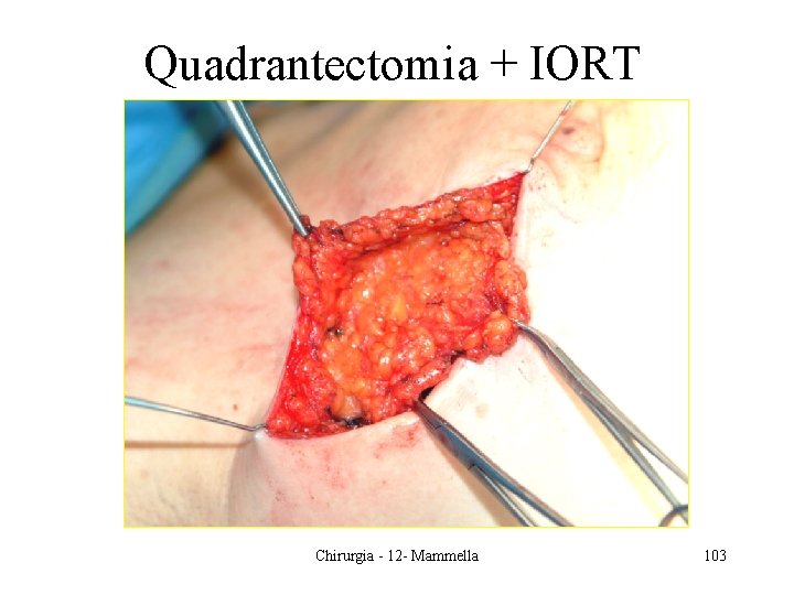 Quadrantectomia + IORT Chirurgia - 12 - Mammella 103 