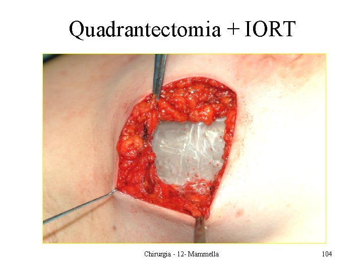 Quadrantectomia + IORT Chirurgia - 12 - Mammella 104 