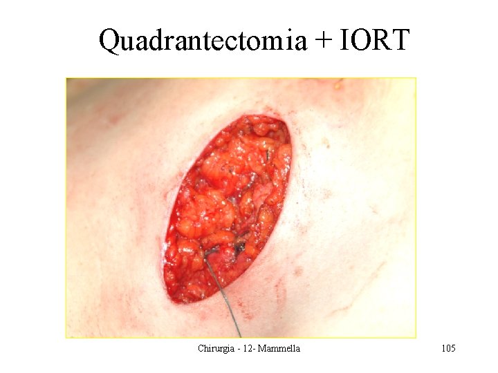 Quadrantectomia + IORT Chirurgia - 12 - Mammella 105 