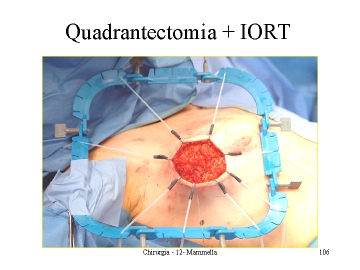 Quadrantectomia + IORT Chirurgia - 12 - Mammella 106 