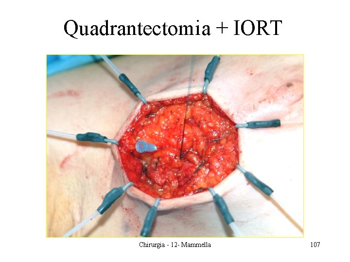 Quadrantectomia + IORT Chirurgia - 12 - Mammella 107 