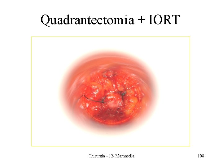 Quadrantectomia + IORT Chirurgia - 12 - Mammella 108 