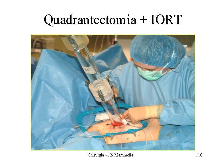 Quadrantectomia + IORT Chirurgia - 12 - Mammella 110 