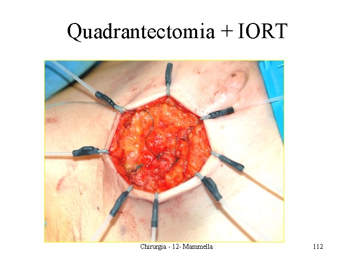 Quadrantectomia + IORT Chirurgia - 12 - Mammella 112 