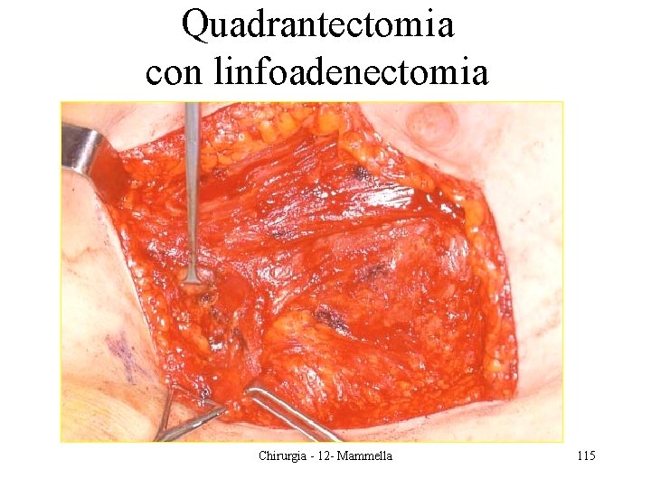 Quadrantectomia con linfoadenectomia Chirurgia - 12 - Mammella 115 