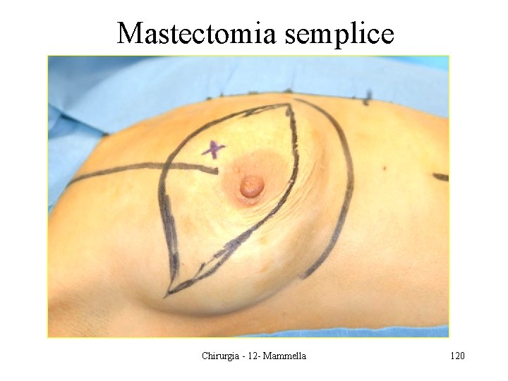 Mastectomia semplice Chirurgia - 12 - Mammella 120 