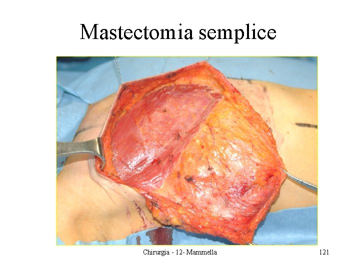 Mastectomia semplice Chirurgia - 12 - Mammella 121 
