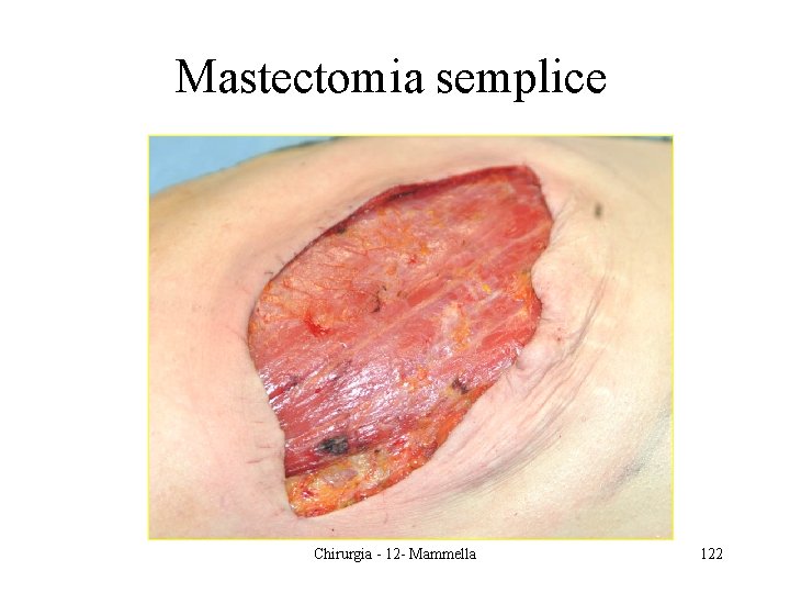 Mastectomia semplice Chirurgia - 12 - Mammella 122 