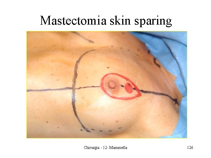 Mastectomia skin sparing Chirurgia - 12 - Mammella 126 