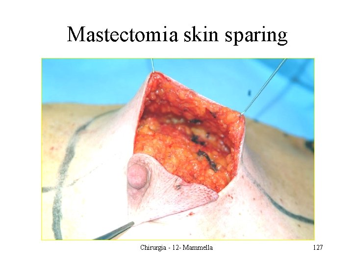 Mastectomia skin sparing Chirurgia - 12 - Mammella 127 