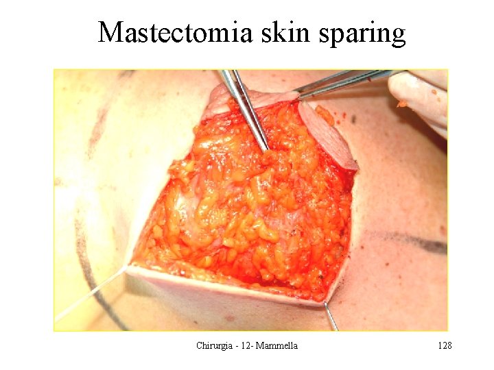 Mastectomia skin sparing Chirurgia - 12 - Mammella 128 