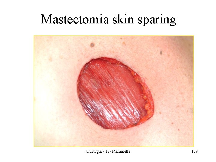 Mastectomia skin sparing Chirurgia - 12 - Mammella 129 