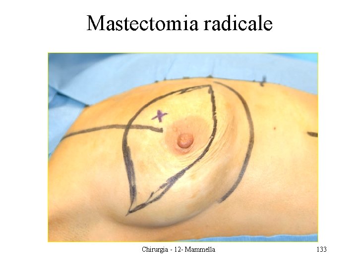 Mastectomia radicale Chirurgia - 12 - Mammella 133 