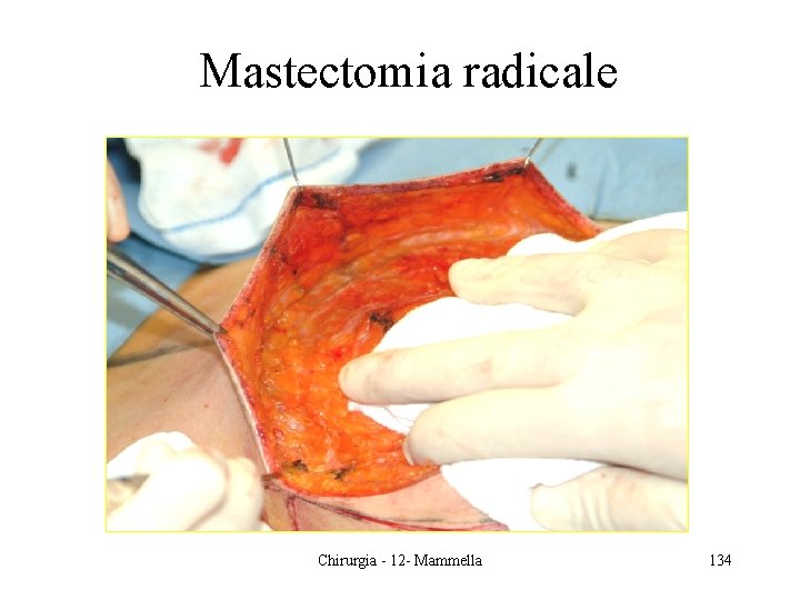 Mastectomia radicale Chirurgia - 12 - Mammella 134 