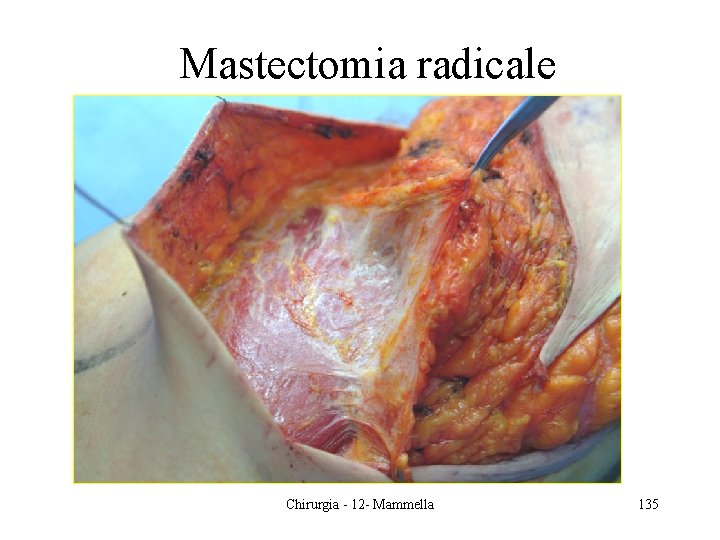 Mastectomia radicale Chirurgia - 12 - Mammella 135 