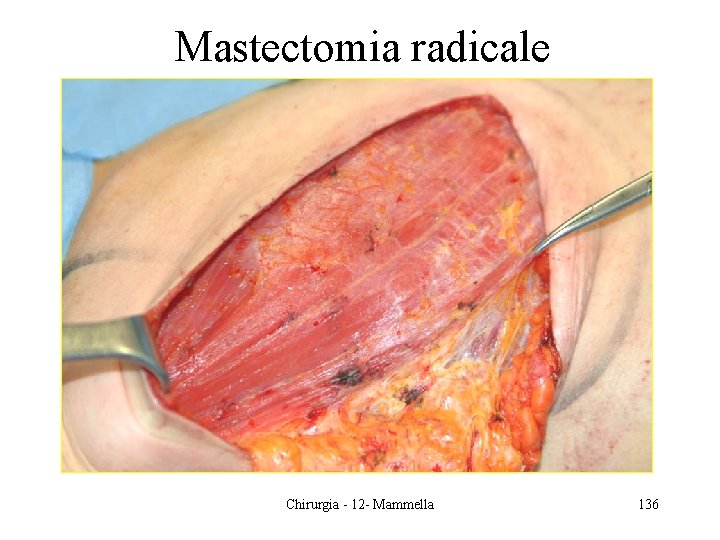 Mastectomia radicale Chirurgia - 12 - Mammella 136 