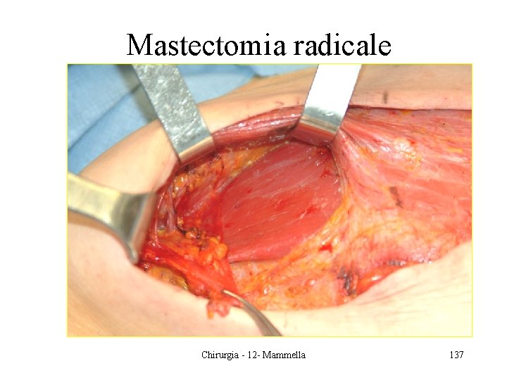 Mastectomia radicale Chirurgia - 12 - Mammella 137 