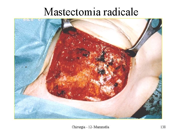 Mastectomia radicale Chirurgia - 12 - Mammella 138 