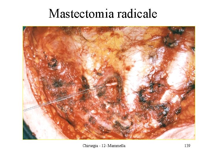 Mastectomia radicale Chirurgia - 12 - Mammella 139 