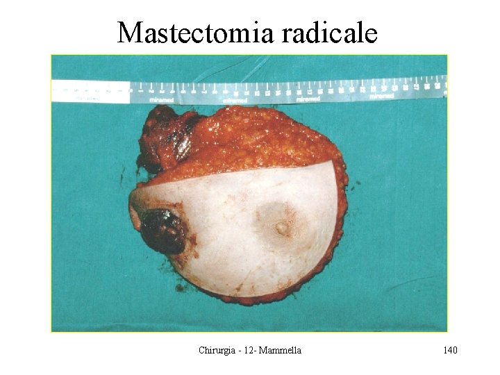 Mastectomia radicale Chirurgia - 12 - Mammella 140 