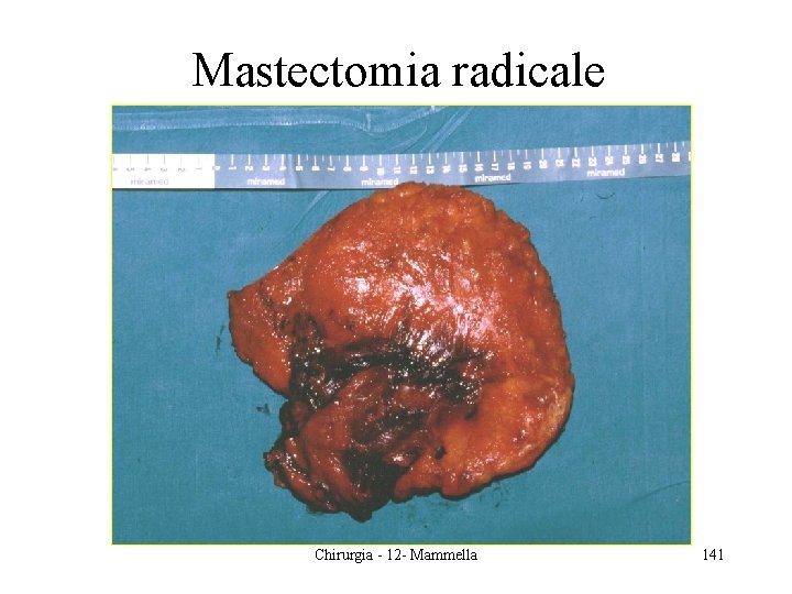 Mastectomia radicale Chirurgia - 12 - Mammella 141 