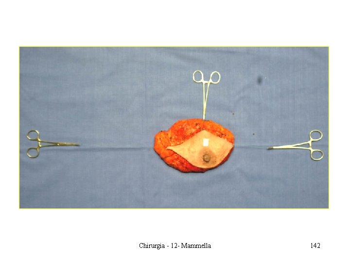 Mappatura dei pezzi operatori Chirurgia - 12 - Mammella 142 