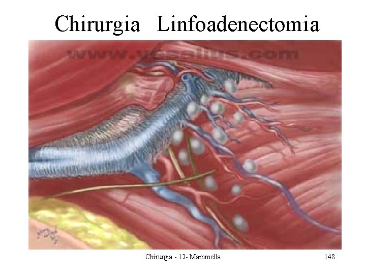 Chirurgia Linfoadenectomia Chirurgia - 12 - Mammella 148 