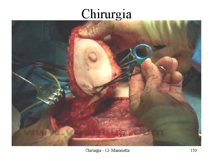 Chirurgia - 12 - Mammella 150 