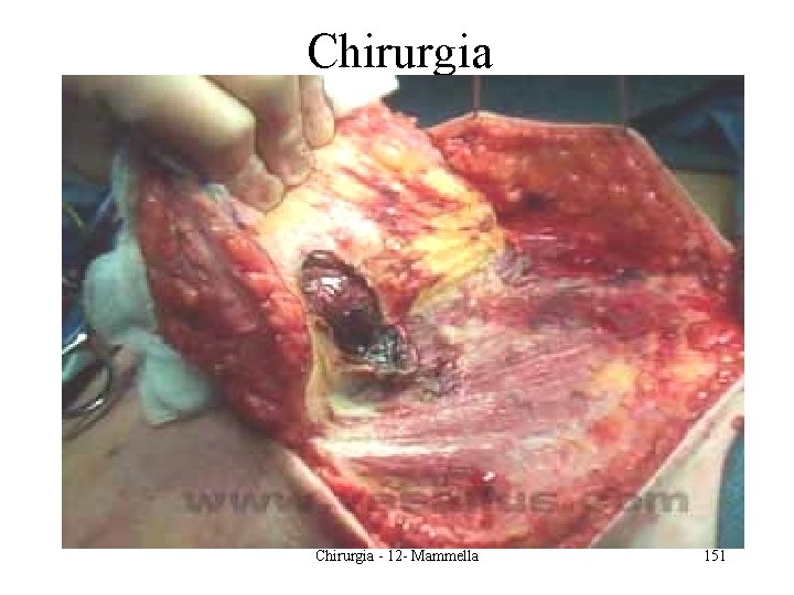 Chirurgia - 12 - Mammella 151 