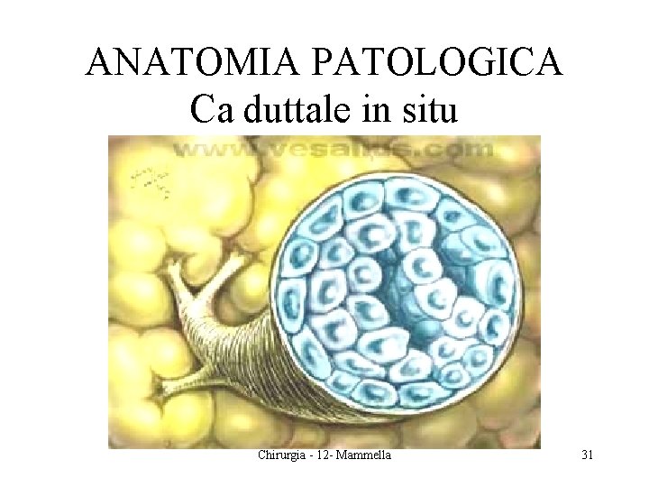 ANATOMIA PATOLOGICA Ca duttale in situ Chirurgia - 12 - Mammella 31 