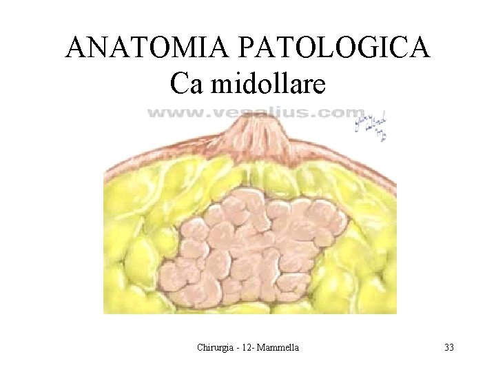 ANATOMIA PATOLOGICA Ca midollare Chirurgia - 12 - Mammella 33 