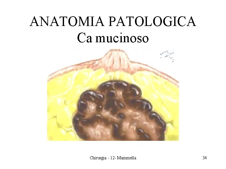 ANATOMIA PATOLOGICA Ca mucinoso Chirurgia - 12 - Mammella 34 