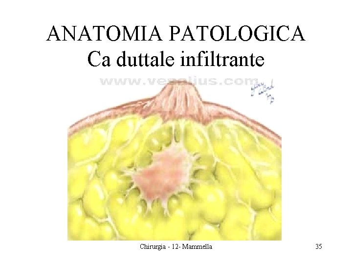 ANATOMIA PATOLOGICA Ca duttale infiltrante Chirurgia - 12 - Mammella 35 