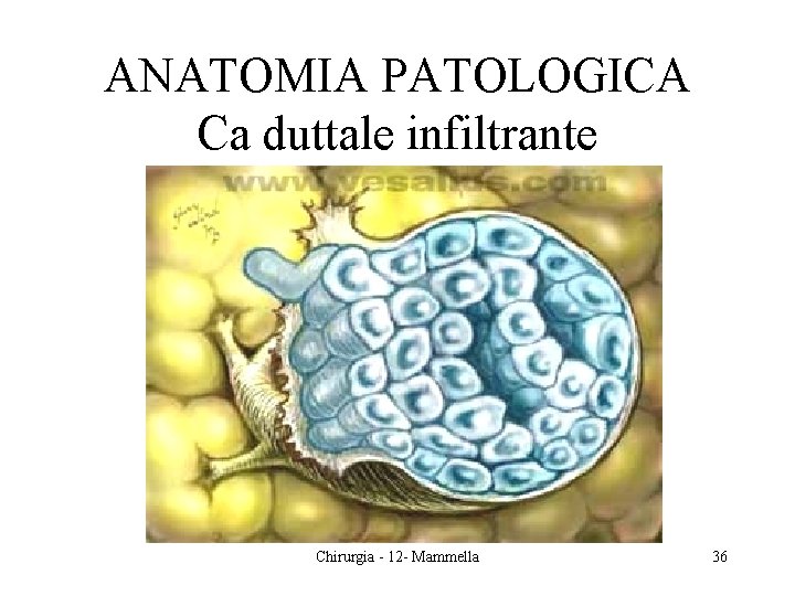 ANATOMIA PATOLOGICA Ca duttale infiltrante Chirurgia - 12 - Mammella 36 