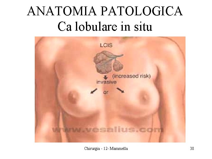 ANATOMIA PATOLOGICA Ca lobulare in situ Chirurgia - 12 - Mammella 38 