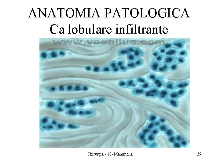 ANATOMIA PATOLOGICA Ca lobulare infiltrante Chirurgia - 12 - Mammella 39 