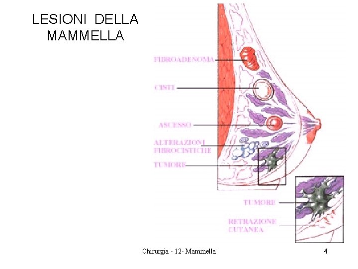 LESIONI DELLA MAMMELLA Chirurgia - 12 - Mammella 4 