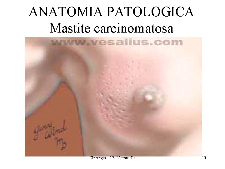 ANATOMIA PATOLOGICA Mastite carcinomatosa Chirurgia - 12 - Mammella 40 