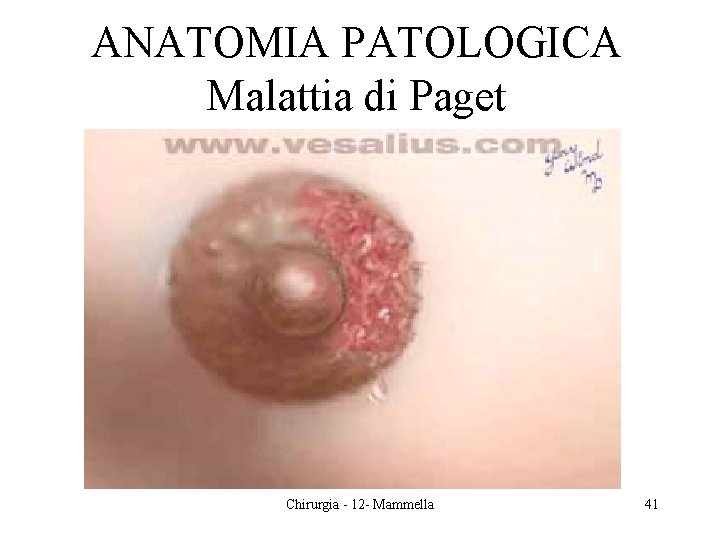 ANATOMIA PATOLOGICA Malattia di Paget Chirurgia - 12 - Mammella 41 