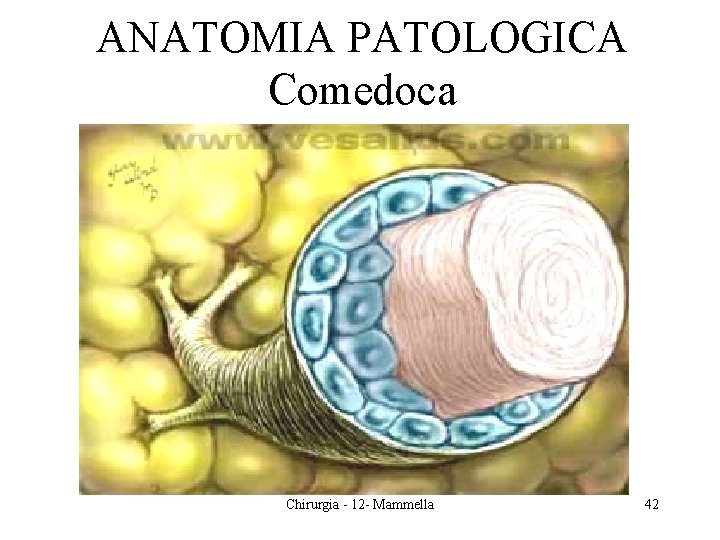 ANATOMIA PATOLOGICA Comedoca Chirurgia - 12 - Mammella 42 