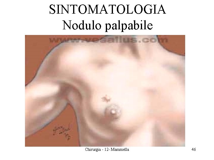 SINTOMATOLOGIA Nodulo palpabile Chirurgia - 12 - Mammella 46 