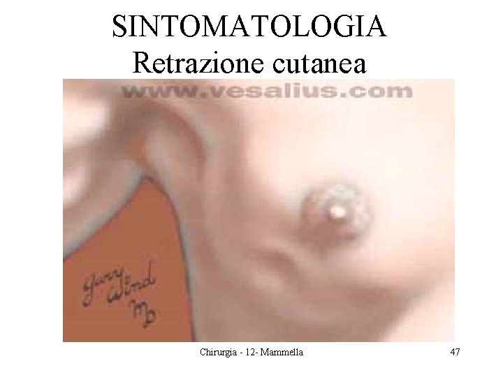 SINTOMATOLOGIA Retrazione cutanea Chirurgia - 12 - Mammella 47 