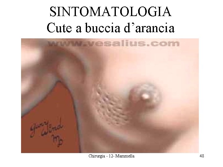 SINTOMATOLOGIA Cute a buccia d’arancia Chirurgia - 12 - Mammella 48 SINTOMATOLOGIA Cute a buccia d’arancia Chirurgia - 12 - Mammella 48