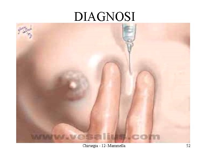 DIAGNOSI Chirurgia - 12 - Mammella 52 