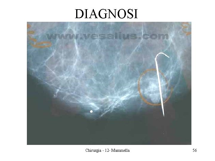DIAGNOSI Chirurgia - 12 - Mammella 56 